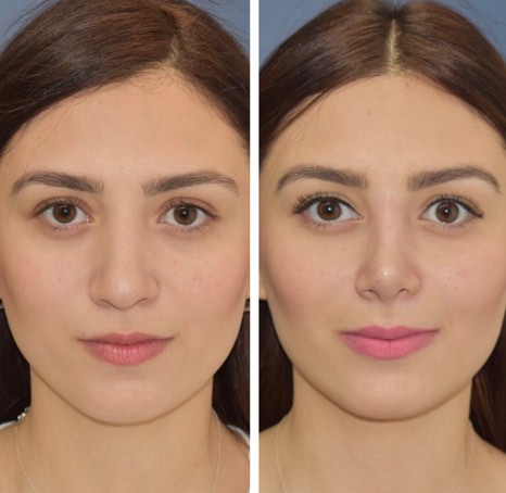 Antes y después de cirugía en rinoplastia